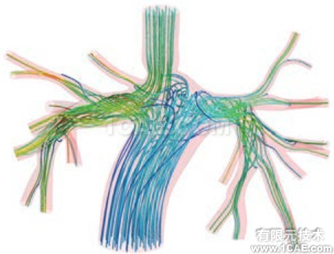 CFD模擬拯救患有致命心臟缺陷的嬰兒 CFD模擬拯救患有致命心臟缺陷的嬰兒